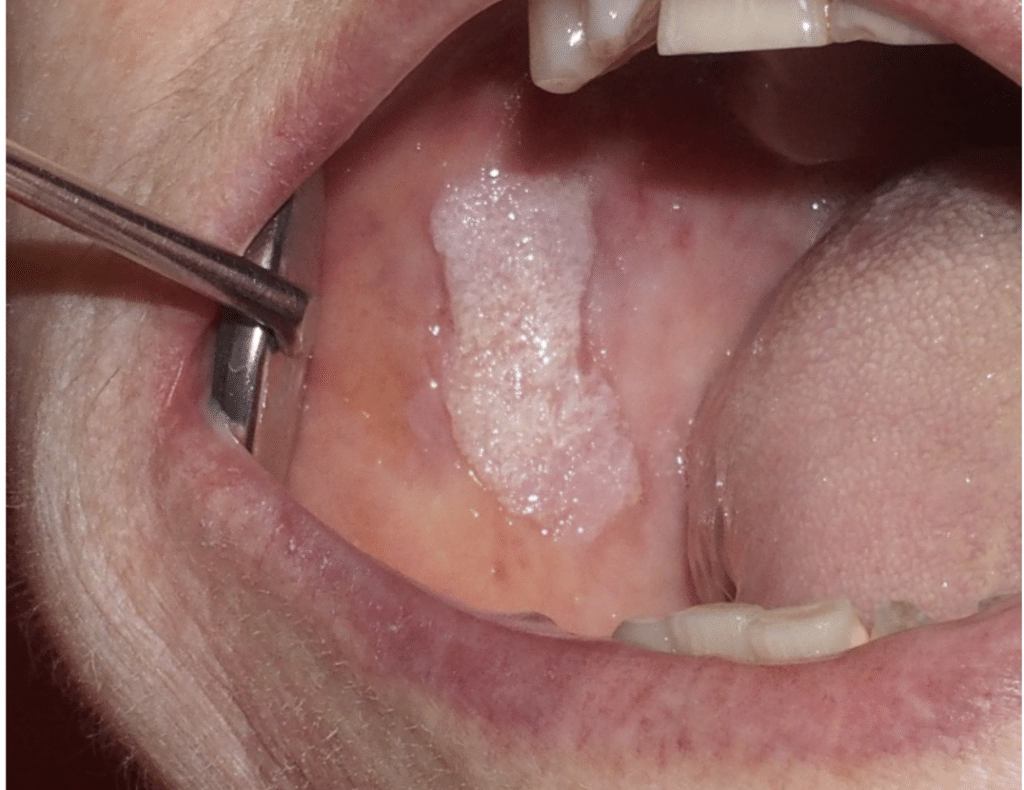 Buccal Cancer Surgery
