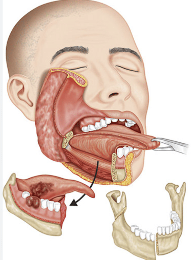 Jaw Cancer Surgery Renda Clinic