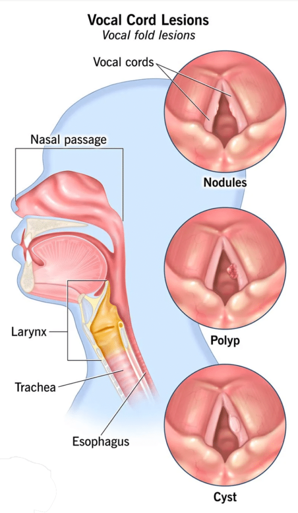 Laryngeal Polyp Surgery Renda Clinic