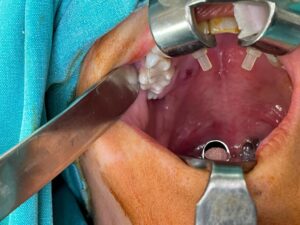 Hard Palate Cancer Surgery 2