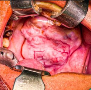 Hard Palate Cancer Surgery